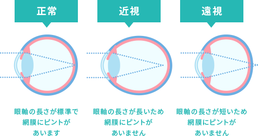 そもそも老眼とは