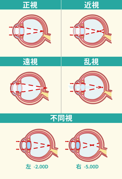 【タイプ別】遠近両用コンタクトと老眼鏡の見え方の違い・注意点