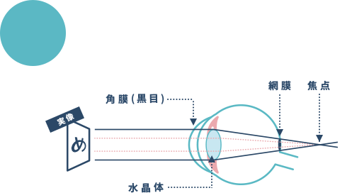 近くが見えにくくなっている状態。遠くのものもピントがあわず、見えにくくなります。
